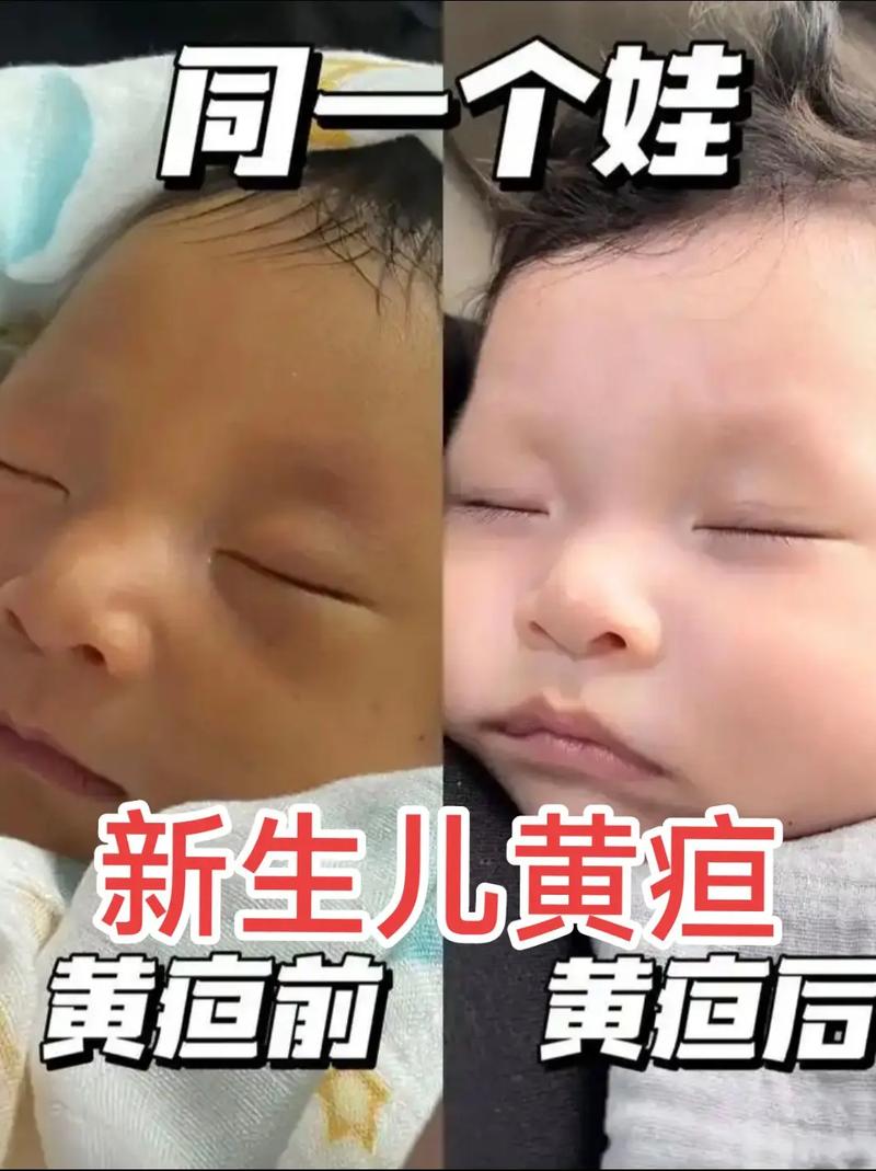 新生儿病理性黄疸有哪些典型症状？如何区分生理性与病理性黄疸？-第2张图片-郑州医学网