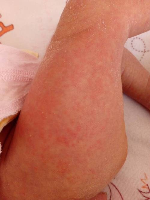 新生儿腿上一大片红色是胎记还是血管瘤？需要担心吗？-第1张图片-郑州医学网