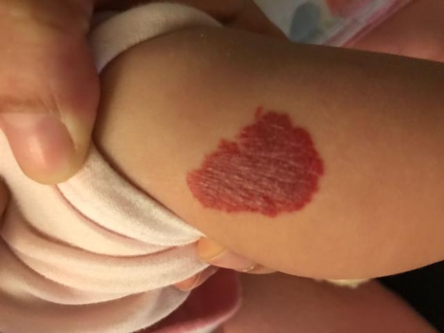 新生儿腿上一大片红色是胎记还是血管瘤？需要担心吗？-第2张图片-郑州医学网