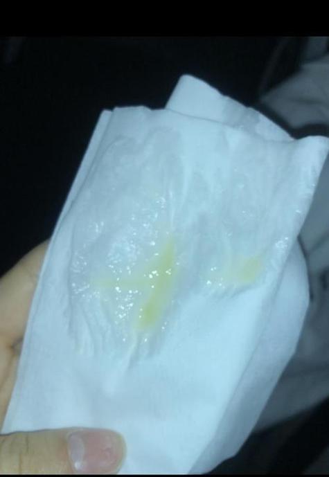 怀孕期间白带发黄希糊-第1张图片-郑州医学网