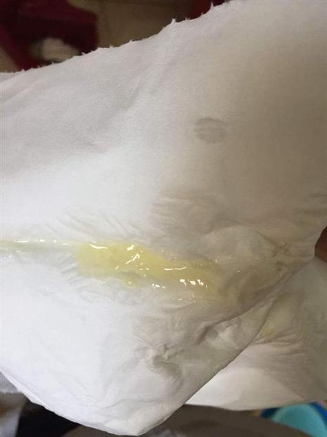 怀孕期间白带发黄希糊-第2张图片-郑州医学网