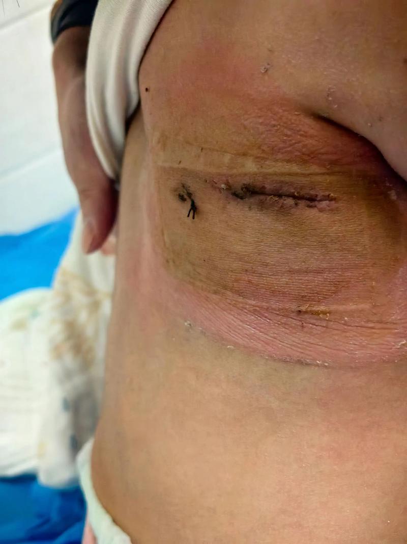 新生儿膈疝手术后会有哪些后遗症？家长该如何应对和护理？-第1张图片-郑州医学网