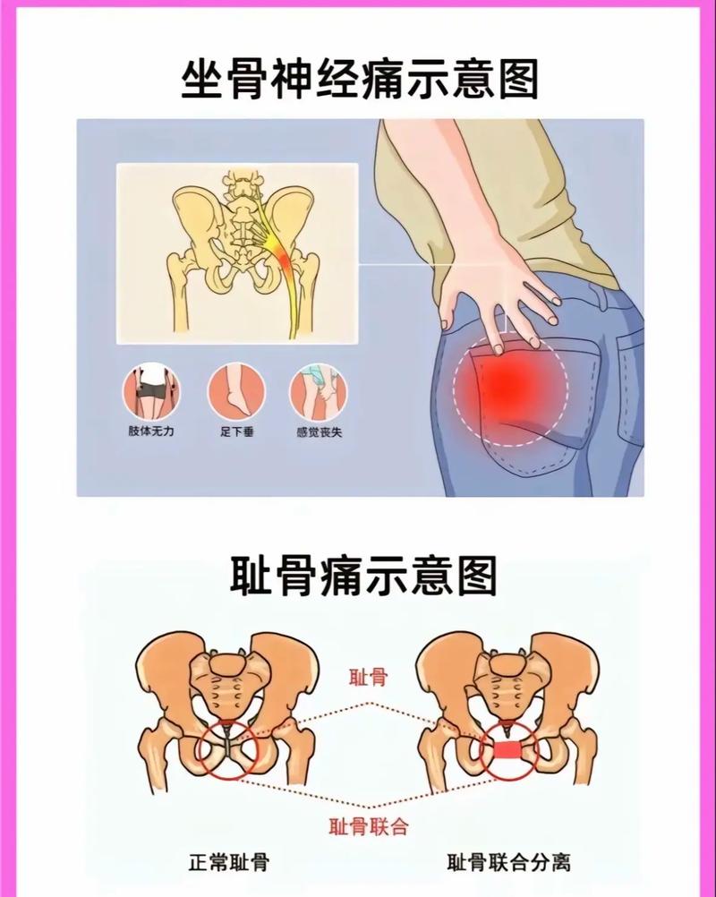 怀孕期间为什么屁股疼-第1张图片-郑州医学网