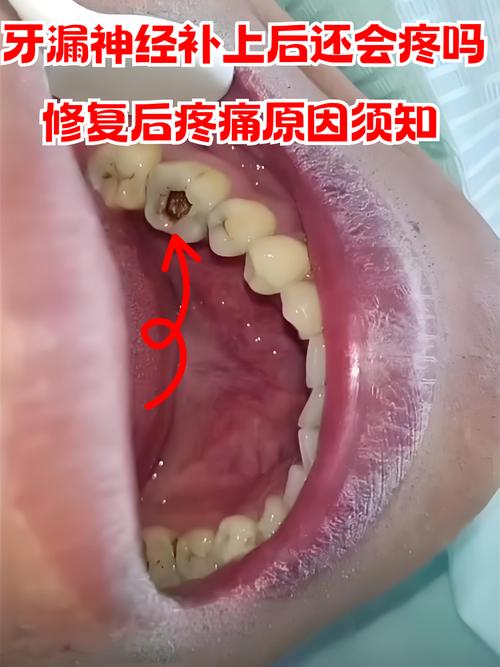 儿童补牙杀神经的危害-第2张图片-郑州医学网