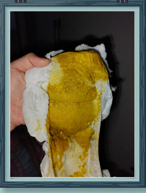 新生儿出生后排便正常吗？需要特别关注哪些情况？-第1张图片-郑州医学网