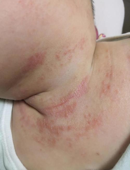 新生儿第二天细菌感染-第1张图片-郑州医学网