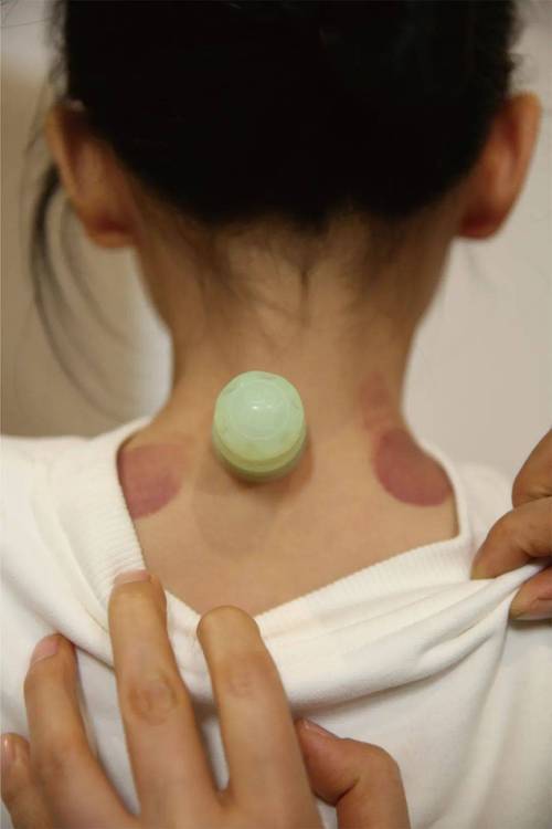 儿童咳嗽拔罐图片大全-第1张图片-郑州医学网 儿童咳嗽拔罐图片大全-第1张图片-郑州医学网