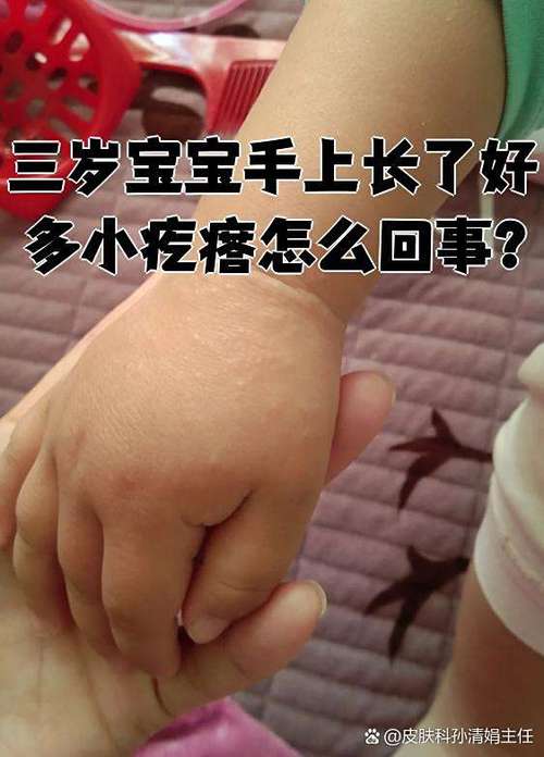 儿童手上长小疙瘩发痒-第1张图片-郑州医学网