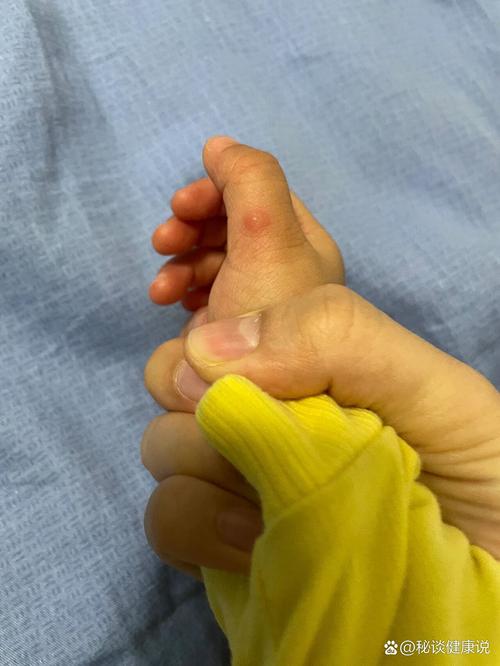 儿童手上长小疙瘩发痒-第2张图片-郑州医学网