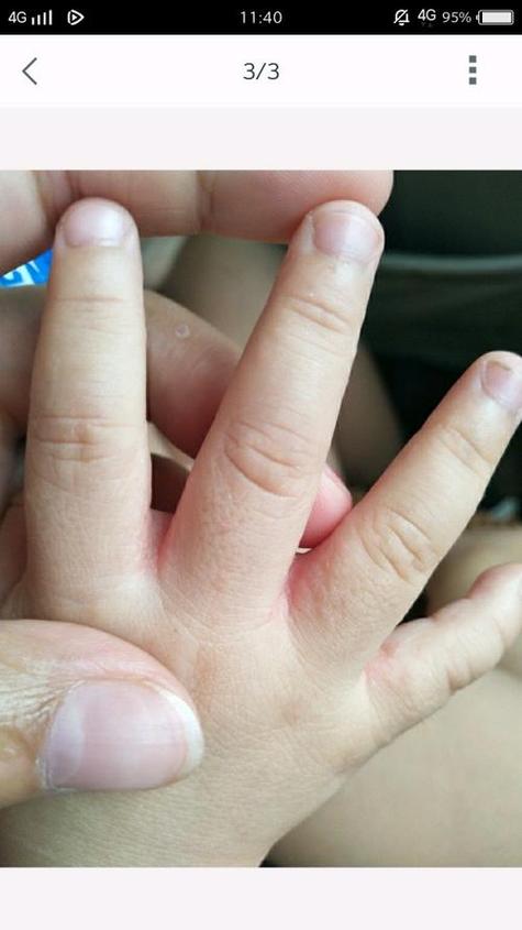 儿童手上长小疙瘩发痒-第3张图片-郑州医学网