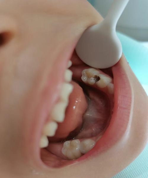 儿童笑气补牙是睡着吗-第1张图片-郑州医学网