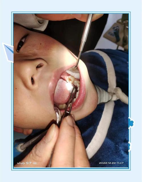 儿童笑气补牙是睡着吗-第2张图片-郑州医学网