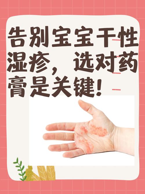 儿童干性皮炎治疗方法-第1张图片-郑州医学网