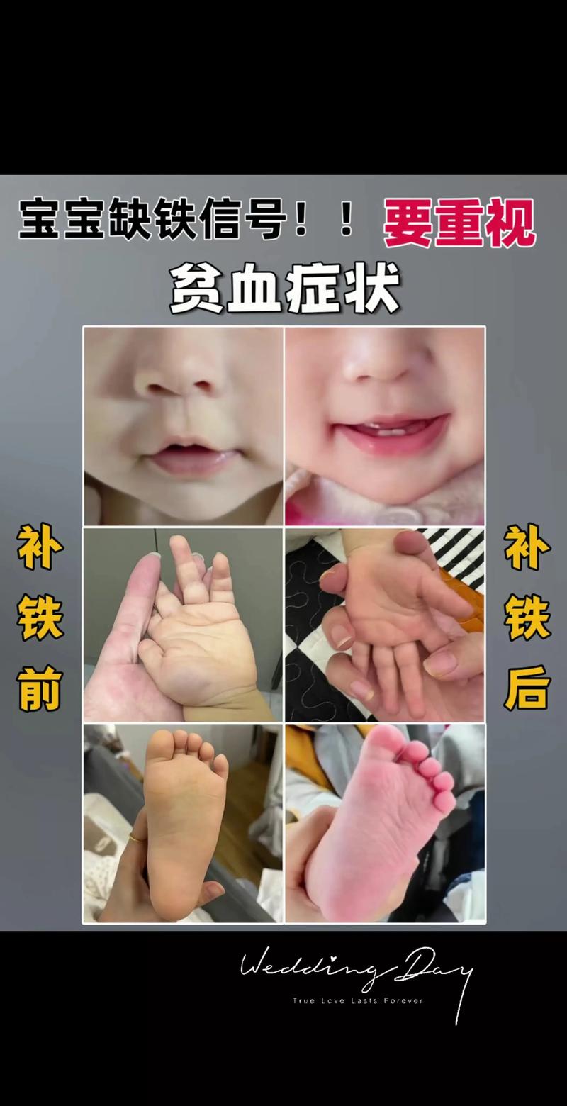 11岁儿童贫血的症状-第1张图片-郑州医学网