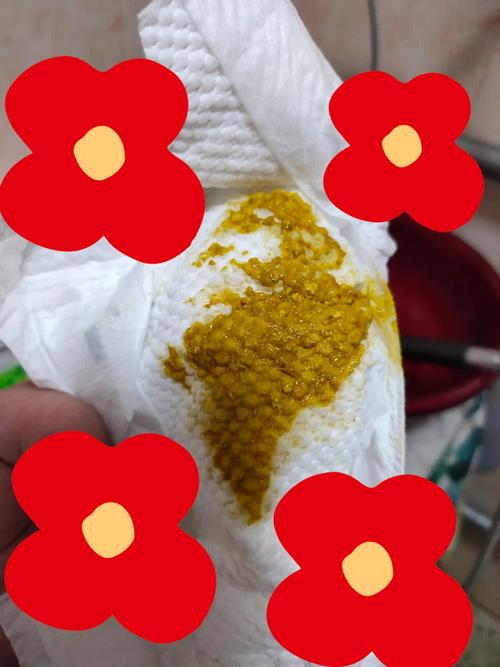 新生儿大便有水和奶瓣是消化不良还是生理性腹泻?-第3张图片-郑州医学网 新生儿大便有水和奶瓣是消化不良还是生理性腹泻?-第3张图片-郑州医学网