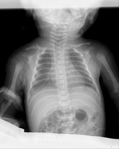 新生儿拍X光片到底会不会对身体造成潜在影响?-第1张图片-郑州医学网 新生儿拍X光片到底会不会对身体造成潜在影响?-第1张图片-郑州医学网