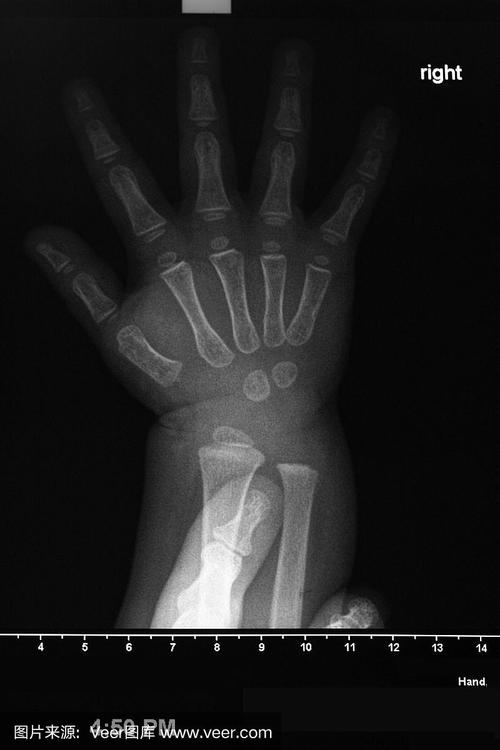 新生儿拍X光片到底会不会对身体造成潜在影响？-第2张图片-郑州医学网