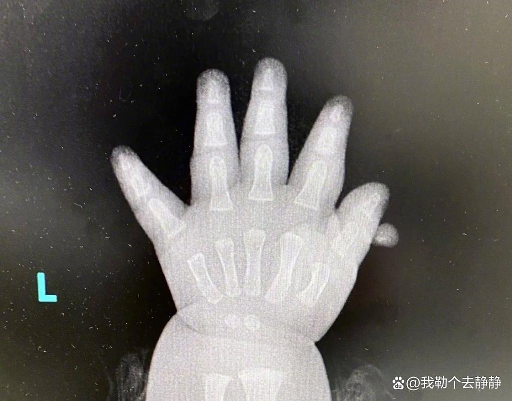 新生儿拍X光片到底会不会对身体造成潜在影响?-第3张图片-郑州医学网 新生儿拍X光片到底会不会对身体造成潜在影响?-第3张图片-郑州医学网