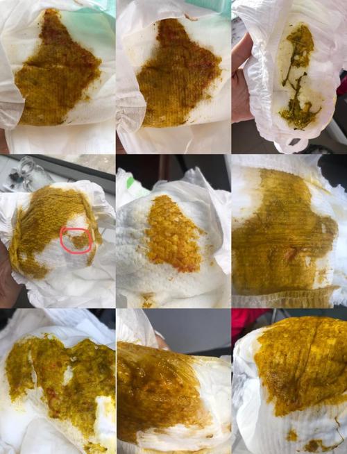 新生儿一直拉尿不拉屎-第1张图片-郑州医学网