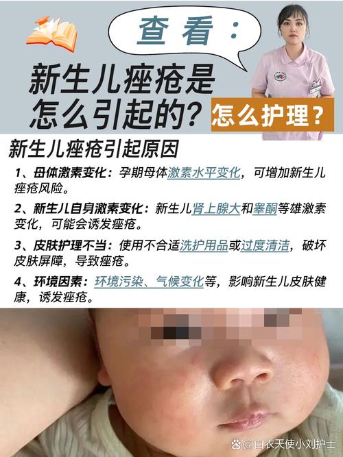 新生儿痤疮留坑怎么办-第2张图片-郑州医学网 新生儿痤疮留坑怎么办-第2张图片-郑州医学网