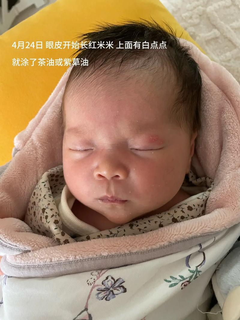 新生儿痤疮留坑怎么办-第3张图片-郑州医学网