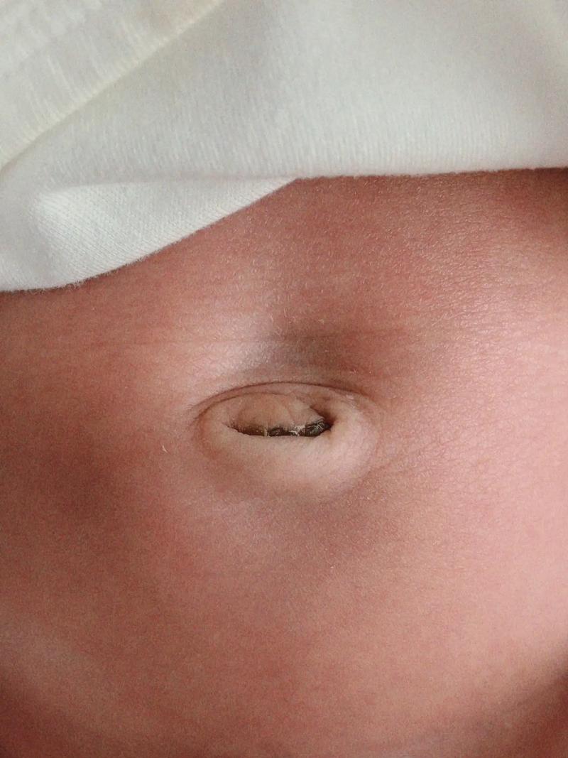 新生儿肚脐眼出现小白点是正常现象还是异常信号？该如何正确护理和处理？-第2张图片-郑州医学网