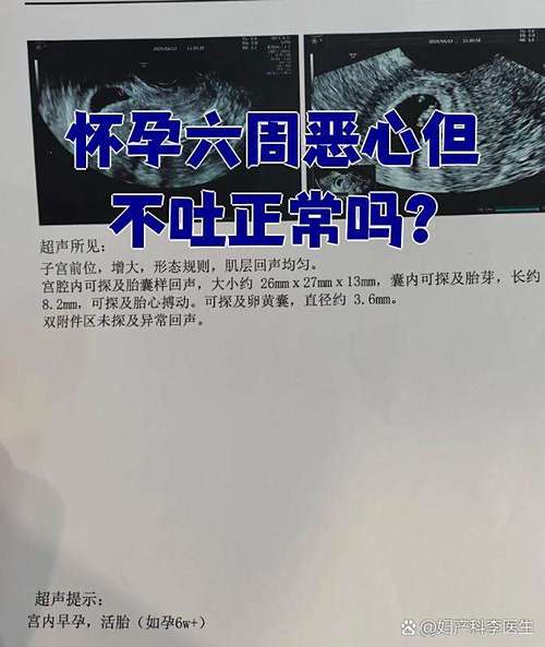 怀孕期间不恶心正常吗-第2张图片-郑州医学网