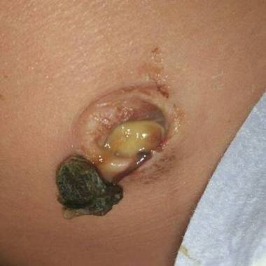 新生儿脐带脱落后有浓液正常吗？需要处理吗？-第2张图片-郑州医学网