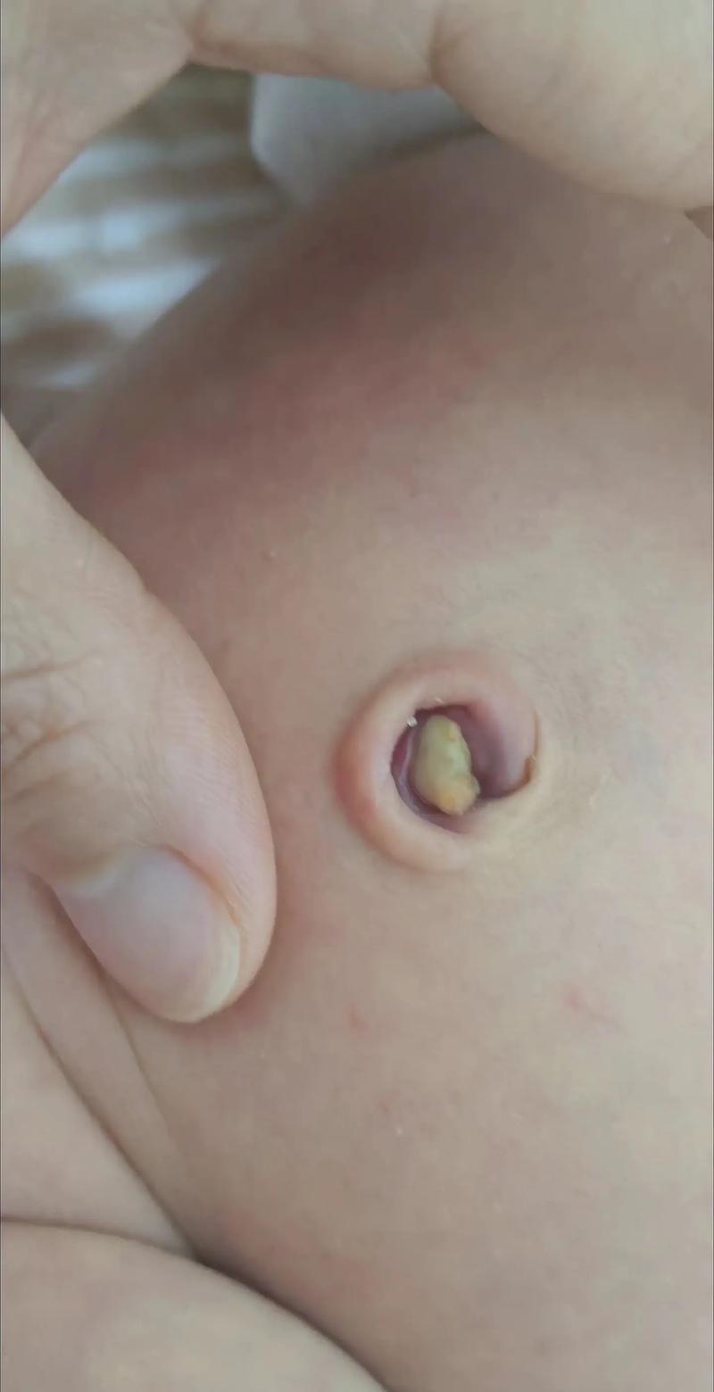 新生儿脐带脱落后有浓液正常吗？需要处理吗？-第1张图片-郑州医学网