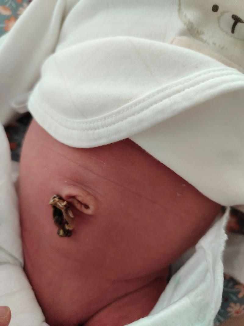 新生儿脐带脱落后有浓液正常吗？需要处理吗？-第3张图片-郑州医学网