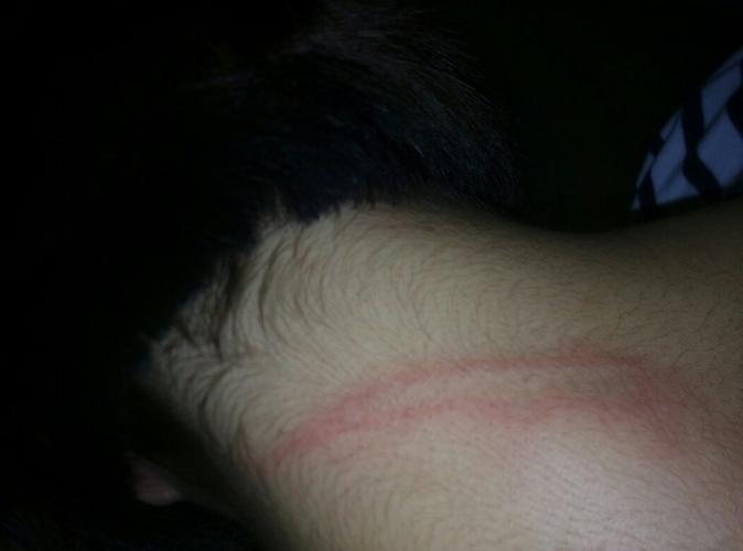 新生儿额头出现黑色斑块是正常现象吗?需要担心什么问题?-第1张图片-郑州医学网 新生儿额头出现黑色斑块是正常现象吗?需要担心什么问题?-第1张图片-郑州医学网