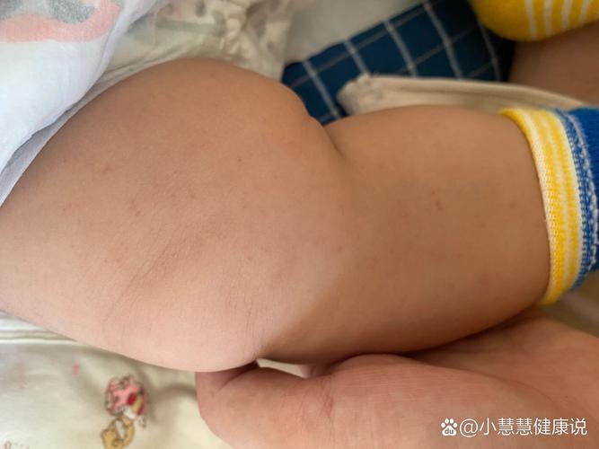 新生儿身上很多出血点-第1张图片-郑州医学网