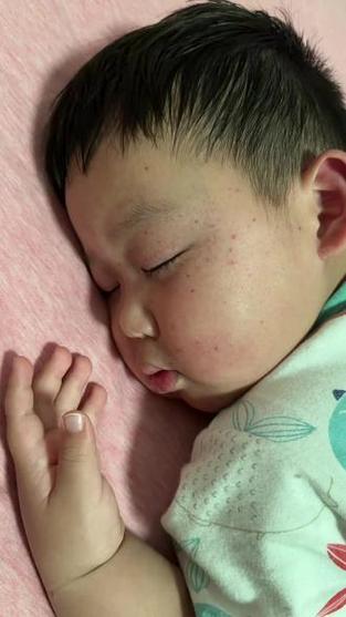 新生儿身上很多出血点-第2张图片-郑州医学网