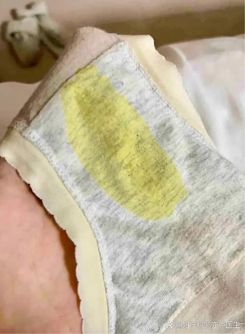 孕期白带发黄像豆腐渣-第1张图片-郑州医学网