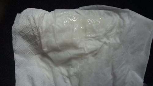 孕期白带发黄像豆腐渣-第2张图片-郑州医学网