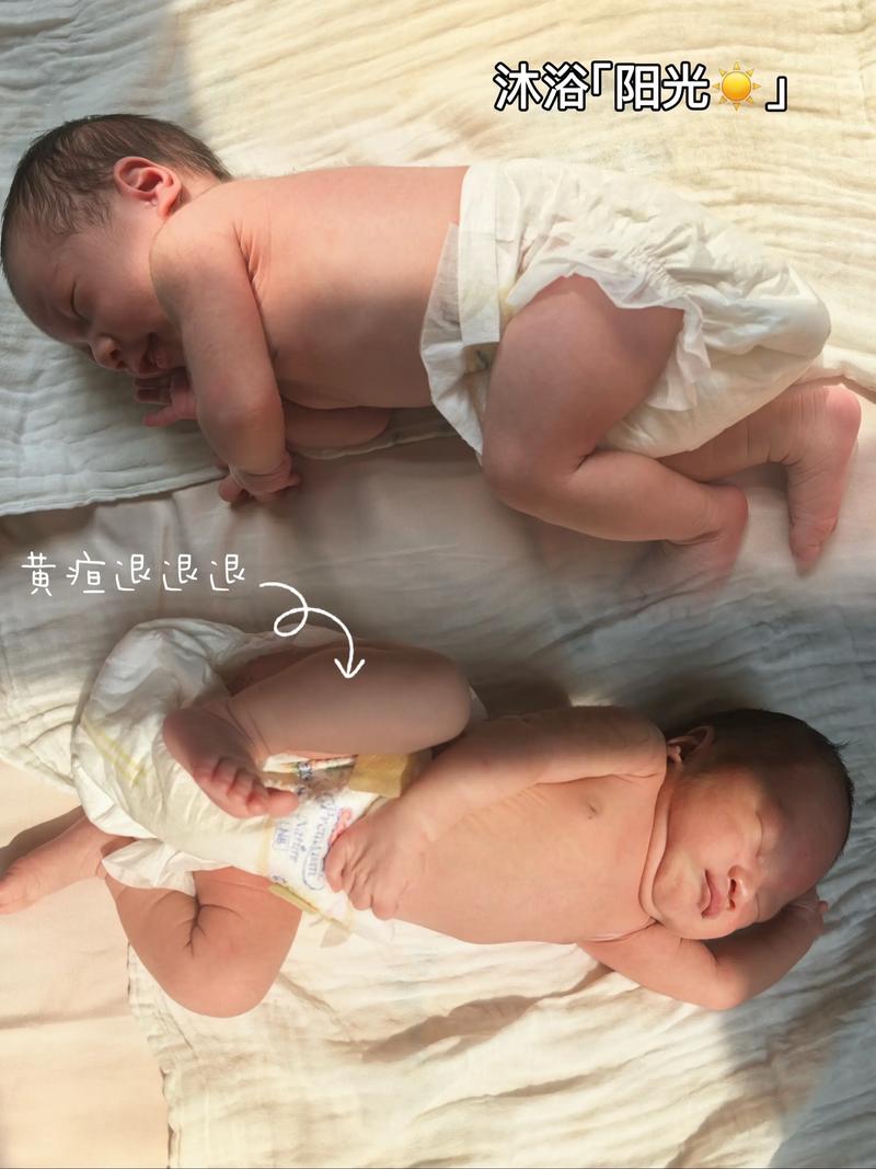 新生儿黄疸晒一个小时-第1张图片-郑州医学网