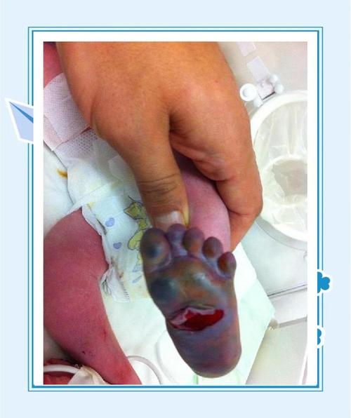 新生儿足底血查地贫吗-第3张图片-郑州医学网