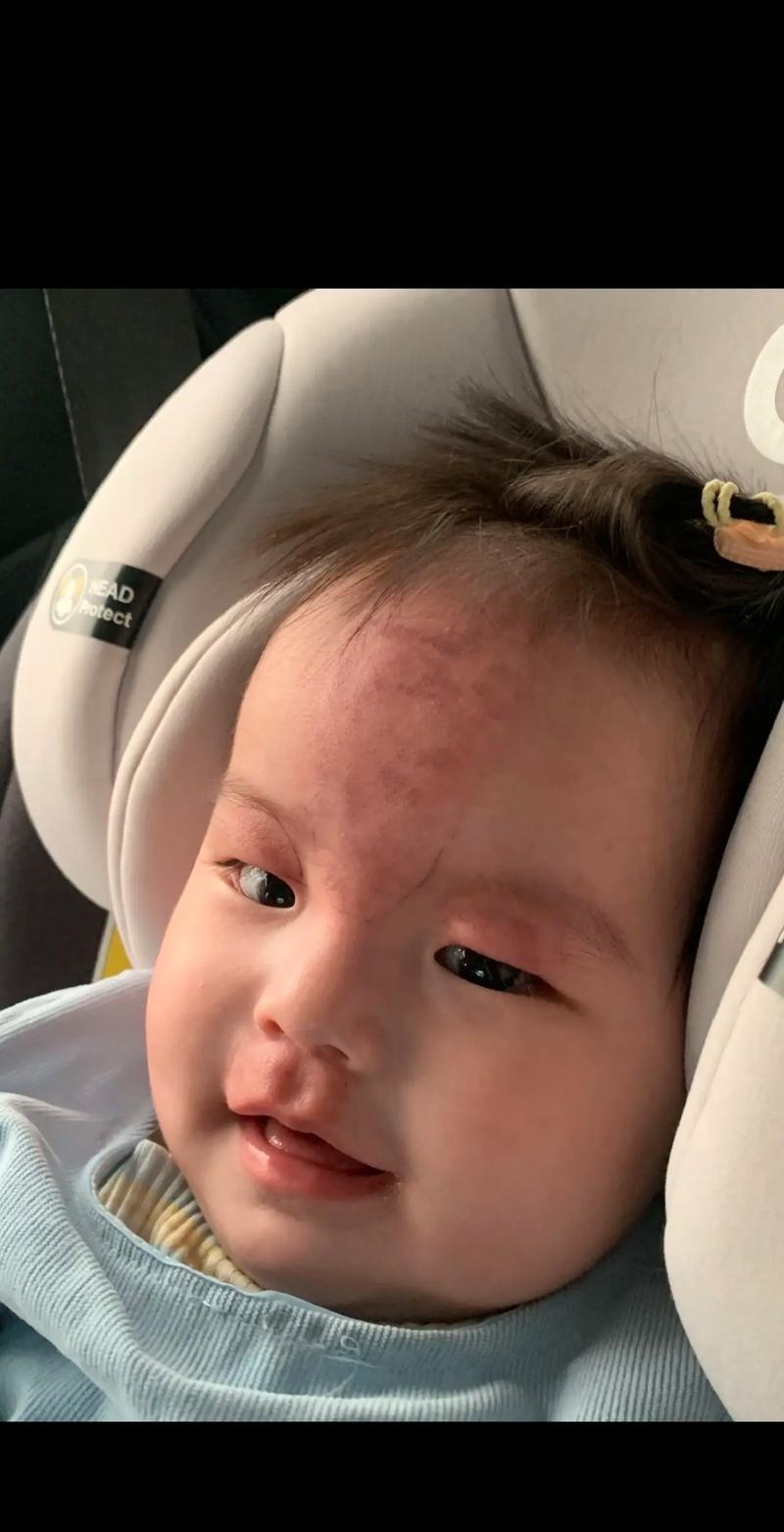 新生儿为什么有鲑鱼斑-第2张图片-郑州医学网