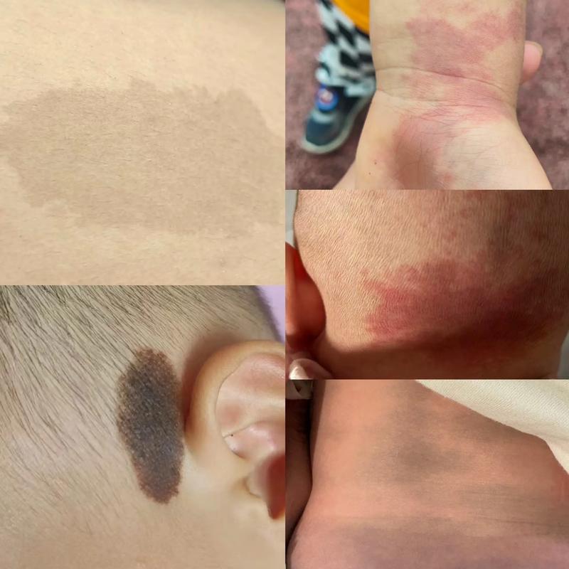 新生儿为什么有鲑鱼斑-第3张图片-郑州医学网