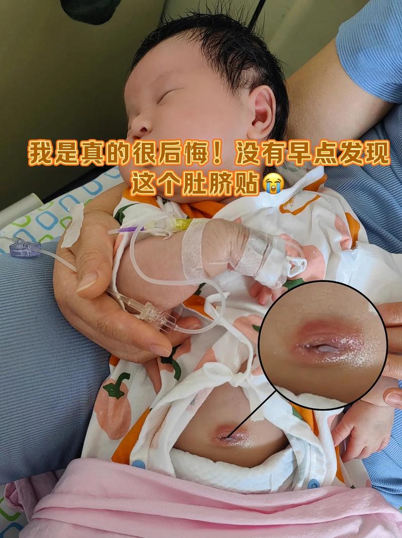 新生儿脐炎多久能治愈-第1张图片-郑州医学网