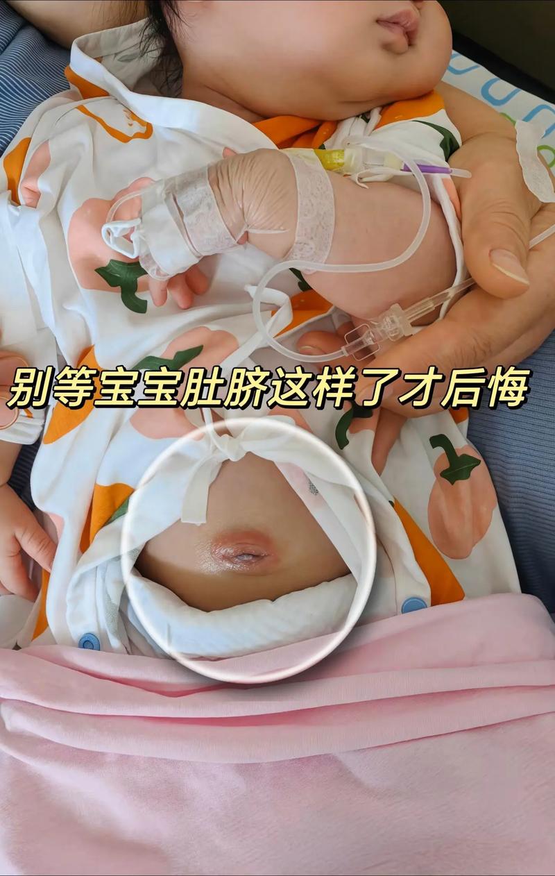 新生儿脐炎多久能治愈-第2张图片-郑州医学网