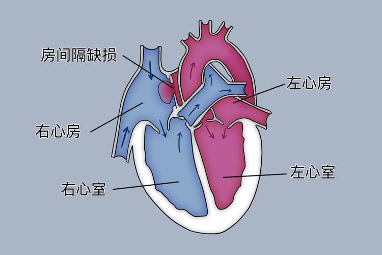 新生儿心房间隔小缺损能自行愈合吗？需治疗吗？会影响发育吗？-第2张图片-郑州医学网