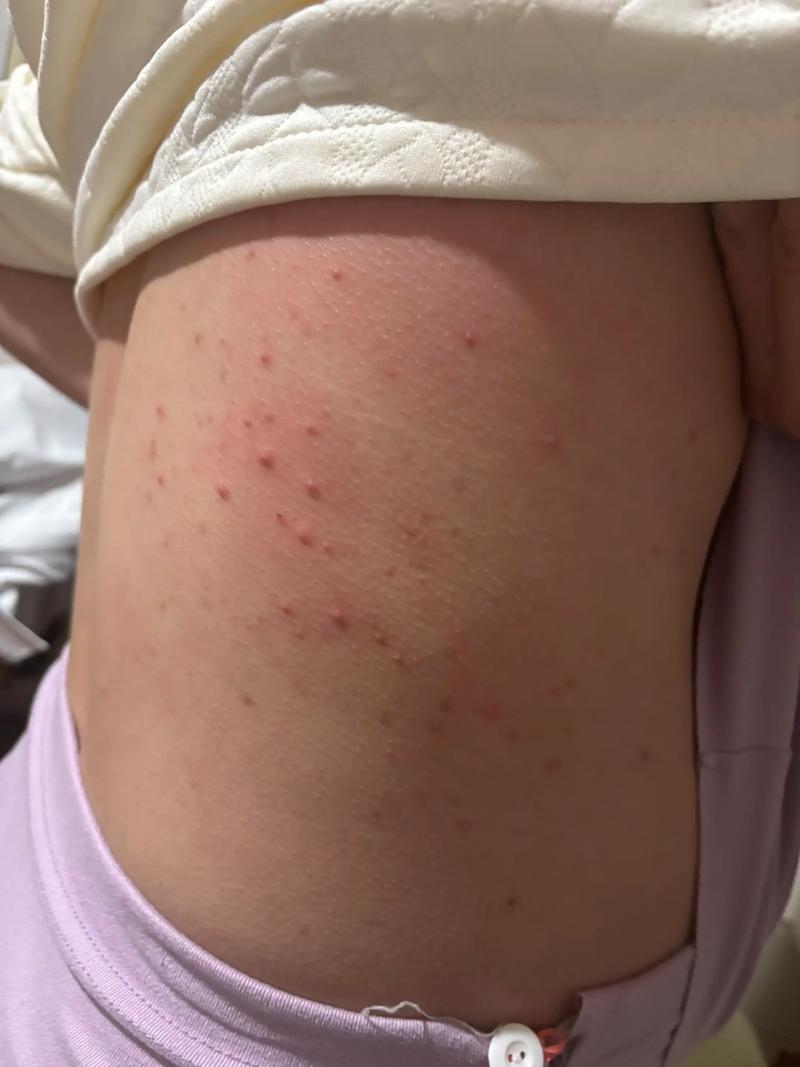 孕期湿疹一般多久会好-第1张图片-郑州医学网