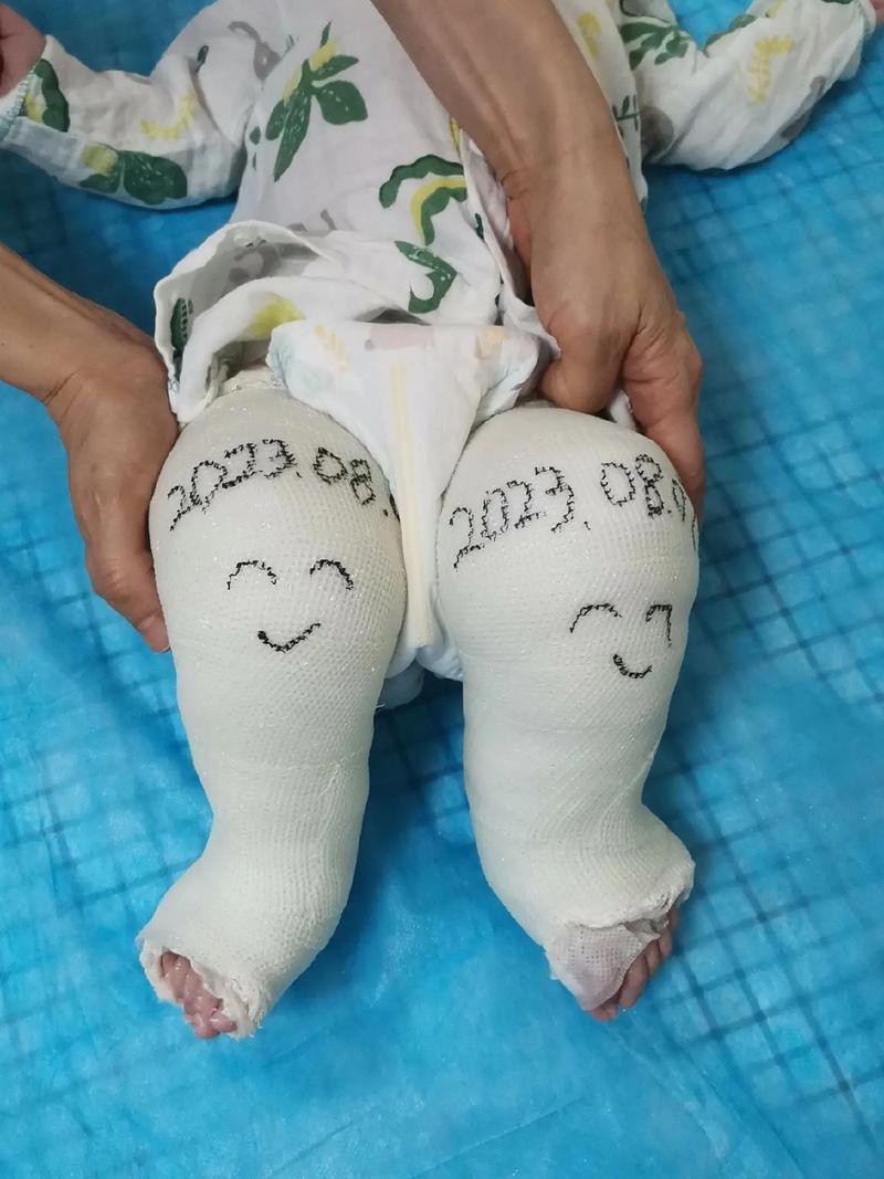 新生儿打石膏注意事项-第1张图片-郑州医学网 新生儿打石膏注意事项-第1张图片-郑州医学网