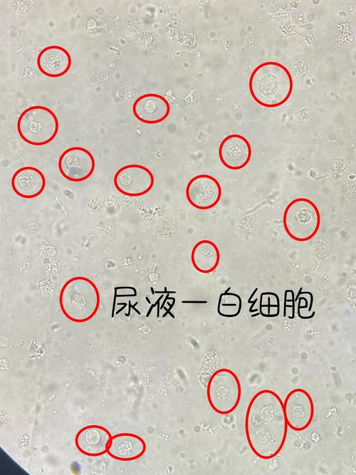 新生儿大便有白细胞是感染信号吗？家长该怎么应对？-第1张图片-郑州医学网