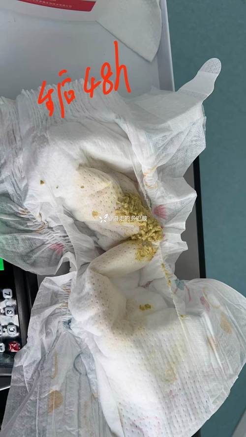 新生儿大便有白细胞是感染信号吗？家长该怎么应对？-第3张图片-郑州医学网