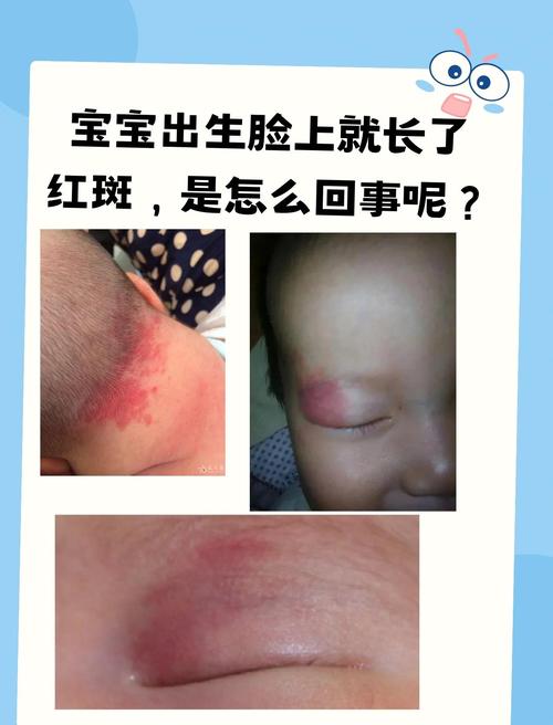 新生儿身上大面积红斑-第2张图片-郑州医学网