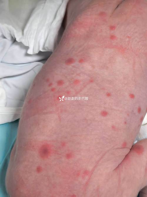 新生儿身上大面积红斑-第3张图片-郑州医学网