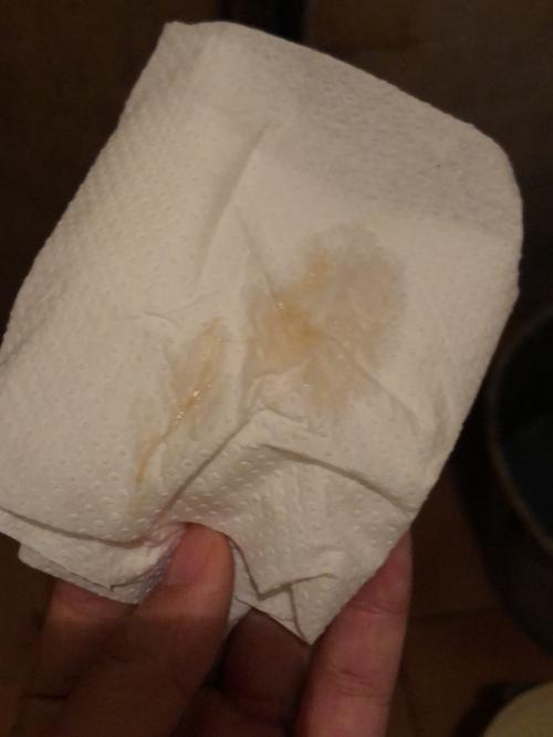 整个孕期见红正常吗?会对胎儿有影响吗?需要怎么处理?-第1张图片-郑州医学网 整个孕期见红正常吗?会对胎儿有影响吗?需要怎么处理?-第1张图片-郑州医学网