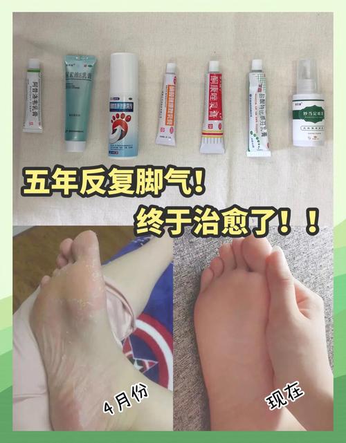 备孕期可以抹脚气膏吗-第1张图片-郑州医学网